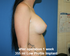plastic-surgery-breast-augmentation